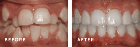 Real Results – See the Difference Orthodontic Treatment Can Make. Before after photos of front teeth before and after Crowding of the teeth procedures