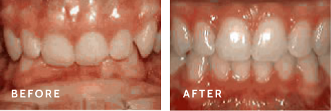 Transform Your Smile. Before after photos of front teeth before and after Deep overbite procedures