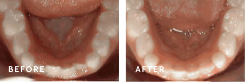 Achieve Your Best Smile – Before & After Success with Schulz Orthodontics. Before after photos of front teeth before and after Non-braces treatment procedures