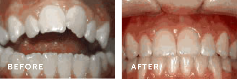 Witness Incredible Smile Transformations – Before & After Treatment. Before after photos of front teeth before and after Open bite procedures
