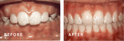 See the Power of Orthodontics – Stunning Smile Transformations. Before after photos of front teeth before and after Overjet procedures