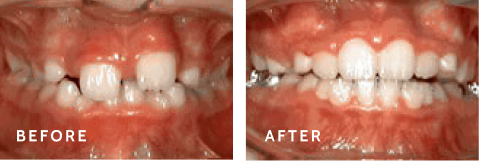 Smiles That Speak for Themselves – Before & After Orthodontic Treatment. Before after photos of front teeth before and after Phase One procedures
