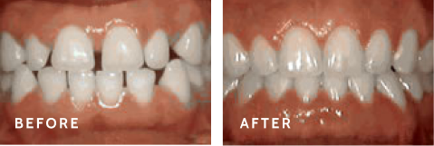Amazing Smile Makeovers – Real Patient Before & After Photos. Before after photos of front teeth before and after Spacing of teeth procedures