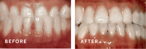 From Consultation to Confident Smile – Before & After Results You’ll Love. Before after photos of front teeth before and after Underbite procedures