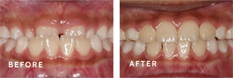 Achieve Your Best Smile – Before & After Transformations at Schulz Orthodontics. Before after photos of front teeth before and after dental procedures case