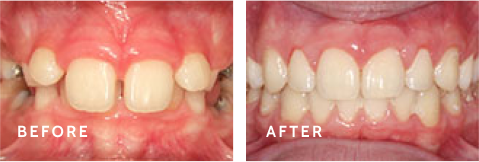 Changing Smiles, Changing Lives – Before & After Results. Before after photos of front teeth before and after dental procedures case