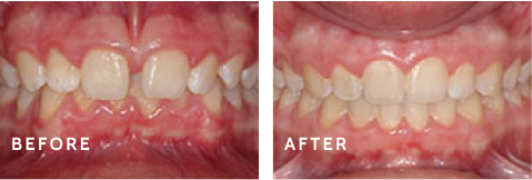 Smile Brighter – Before & After Success Stories from Schulz Orthodontics. Before after photos of front teeth before and after dental procedures case