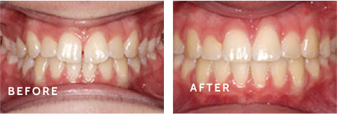 Before & After at Schulz Orthodontics – Real Smiles, Real Results. Before after photos of front teeth before and after dental procedures case