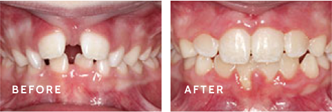 See the Transformation – Before & After Smiles at Schulz Orthodontics. Before after photos of front teeth before and after dental procedures case