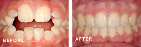 Amazing Smiles Begin Here – Transformations at Schulz Orthodontics. Before after photos of front teeth before and after dental procedures case