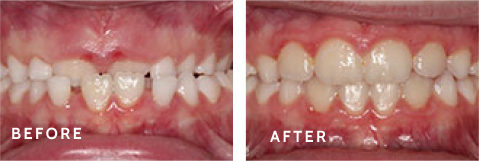Life-Changing Smile Transformations at Schulz Orthodontics. Before after photos of front teeth before and after dental procedures case