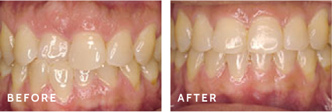 From Ordinary to Extraordinary – Smile Transformations at Schulz Orthodontics. Before after photos of front teeth before and after dental procedures case