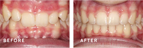 Transform Your Confidence with a New Smile – Schulz Orthodontics. Before after photos of front teeth before and after dental procedures case