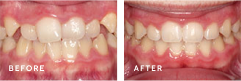 Bringing Smiles to Life – Real Before & After Results at Schulz Orthodontics. Before after photos of front teeth before and after dental procedures case