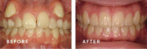 See the Amazing Smile Transformations at Schulz Orthodontics. Before after photos of front teeth before and after dental procedures case