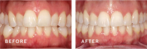 See the Difference – Smile Makeovers at Schulz Orthodontics. Before after photos of front teeth before and after dental procedures case