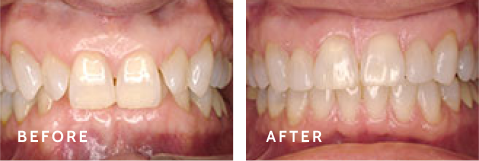 Real Results, Real Smiles – Before & After at Schulz Orthodontics. Before after photos of front teeth before and after dental procedures case
