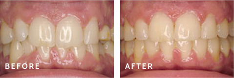 Witness the Power of a Beautiful Smile Transformation. Before after photos of front teeth before and after dental procedures case
