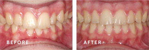 From Start to Finish – Stunning Smile Makeovers at Schulz Orthodontics. Before after photos of front teeth before and after dental procedures case