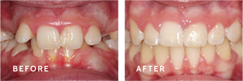 Creating Smiles That Last – Schulz Orthodontics Transformations. Before after photos of front teeth before and after dental procedures case