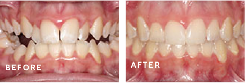 Before & After: See How Schulz Orthodontics Transforms Lives. Before after photos of front teeth before and after dental procedures case