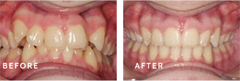 The Schulz Orthodontics Difference – Incredible Smile Transformations. Before after photos of front teeth before and after dental procedures case