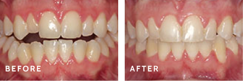 Transform Your Smile with Schulz Orthodontics – Before & After. Before after photos of front teeth before and after dental procedures