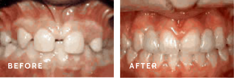 Discover How Orthodontics Can Change Your Smile – Before & After Results. Before after photos of front teeth before and after lateral incisors procedures