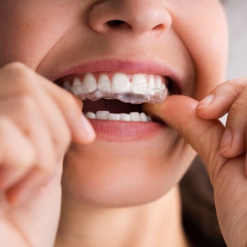 Transform Your Smile with Clear Aligners – Discreet, Comfortable, Effective. Smile with Clear Aligners