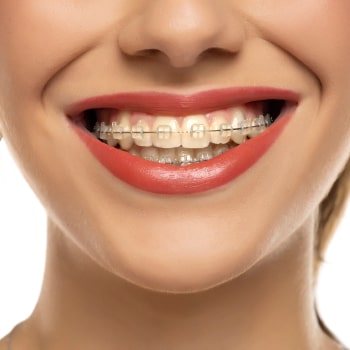 Clear (Ceramic) Braces – A Subtle Solution for a Beautiful Smile. Smile with Clear (Ceramic) Braces