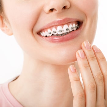Experience the Benefits of Self-Ligating Braces – Faster, More Comfortable Treatment. Smile with Self-Ligating Braces