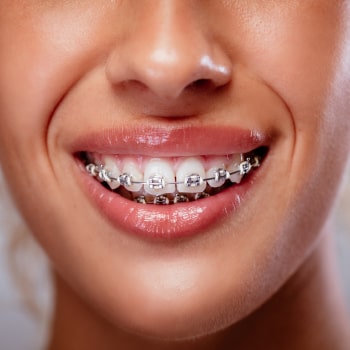 Discover Traditional Metal Braces – The Classic Way to Straighten Your Smile. Smile with Traditional Metal Braces