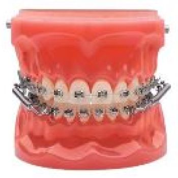 Enhance Your Treatment with Forsus™ – The Efficient Solution for Bite Correction. Forsus