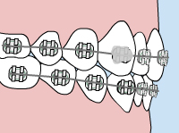 Fixing a Loose Bracket – What You Need to Know for Immediate Relief. Infographics Loose Bracket Adjustments