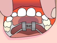 Drawing of Palatal expander on the upper jaw