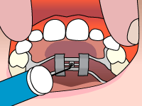 Drawing of Palatal expander on the upper jaw
