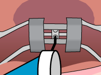 Drawing of Palatal expander mechanism