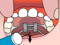 Drawing of Palatal expander mechanism with an arrow pointing outwards