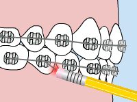 Here’s How to Alleviate Discomfort and Get Back on Track. Poking wire adjustments infographics